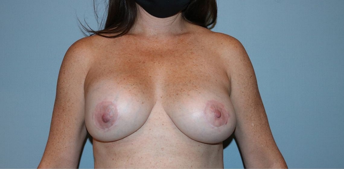 before breast lift front view of female patient 571 at Paydar Plastic Surgery