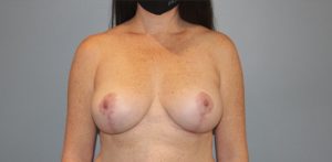 Patient Breast Lift After 0