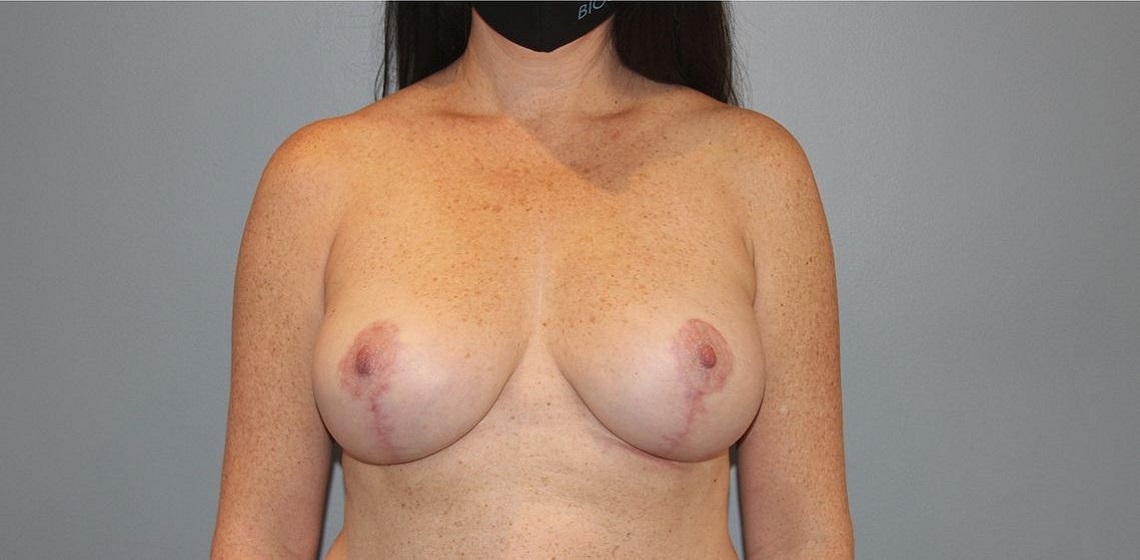 Patient Breast Lift Before 0