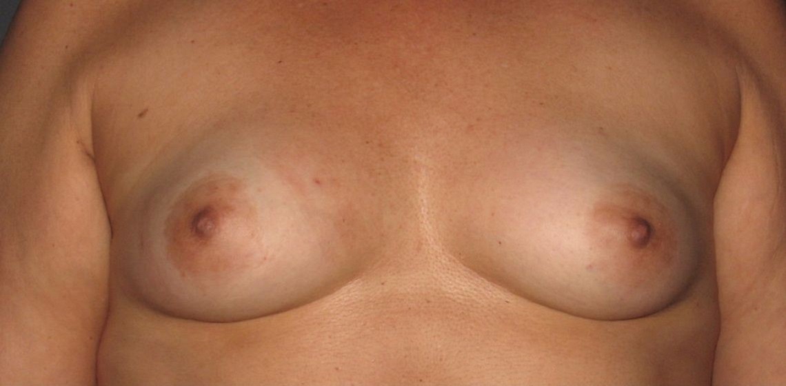 before breast reconstruction front view of female patient 702 at Paydar Plastic Surgery