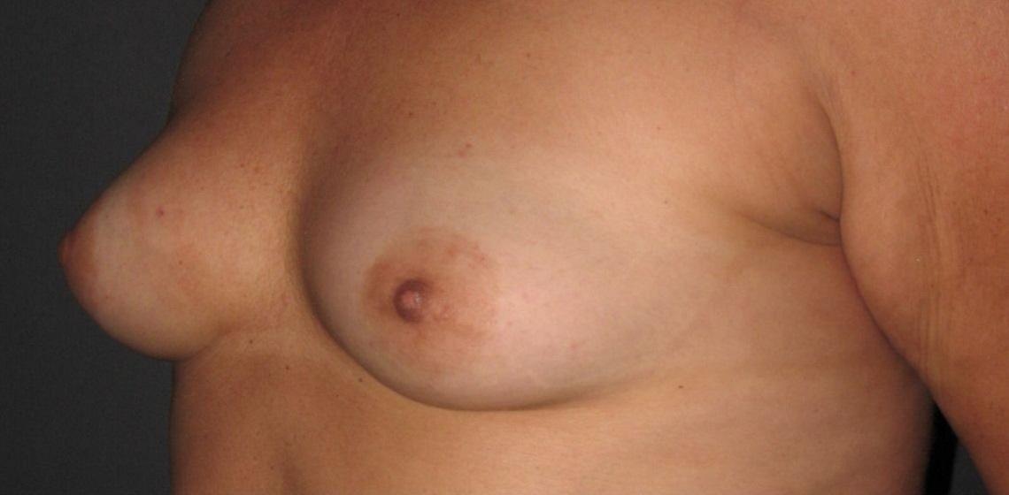 before breast reconstruction front view of female patient 702 at Paydar Plastic Surgery