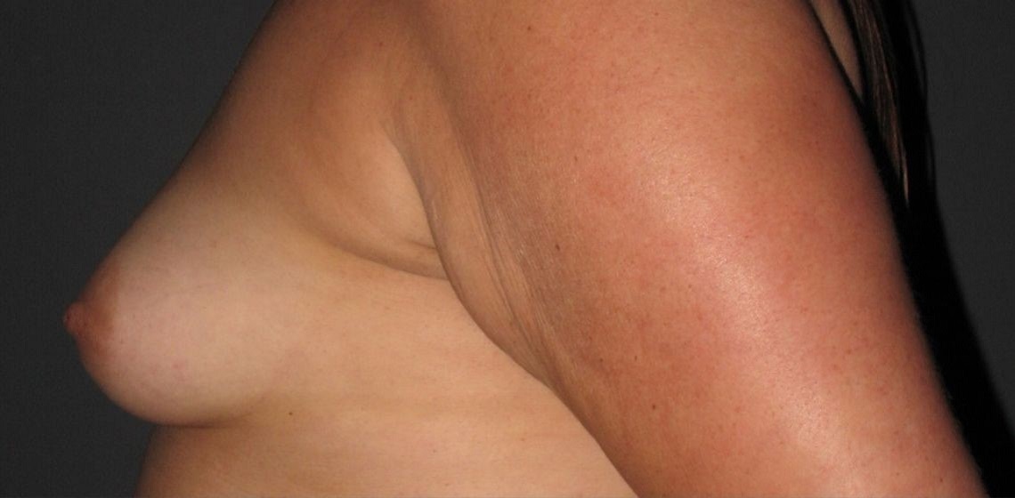before breast reconstruction left view of female patient 702 at Paydar Plastic Surgery