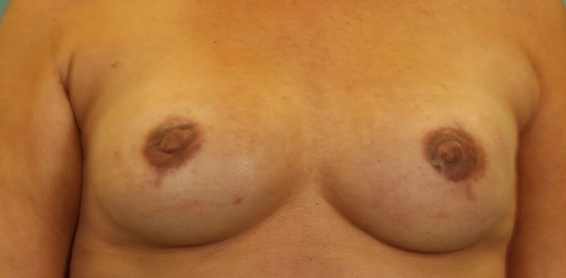 after breast reconstruction front view of female patient 702 at Paydar Plastic Surgery