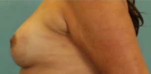 after breast reconstruction left view of female patient 702 at Paydar Plastic Surgery