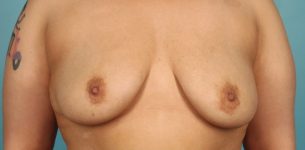 before breast reconstruction front view of female patient 716 at Paydar Plastic Surgery