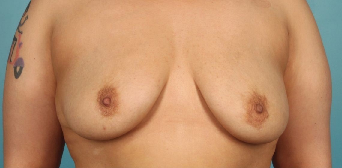 Patient Breast Reconstruction Before 0