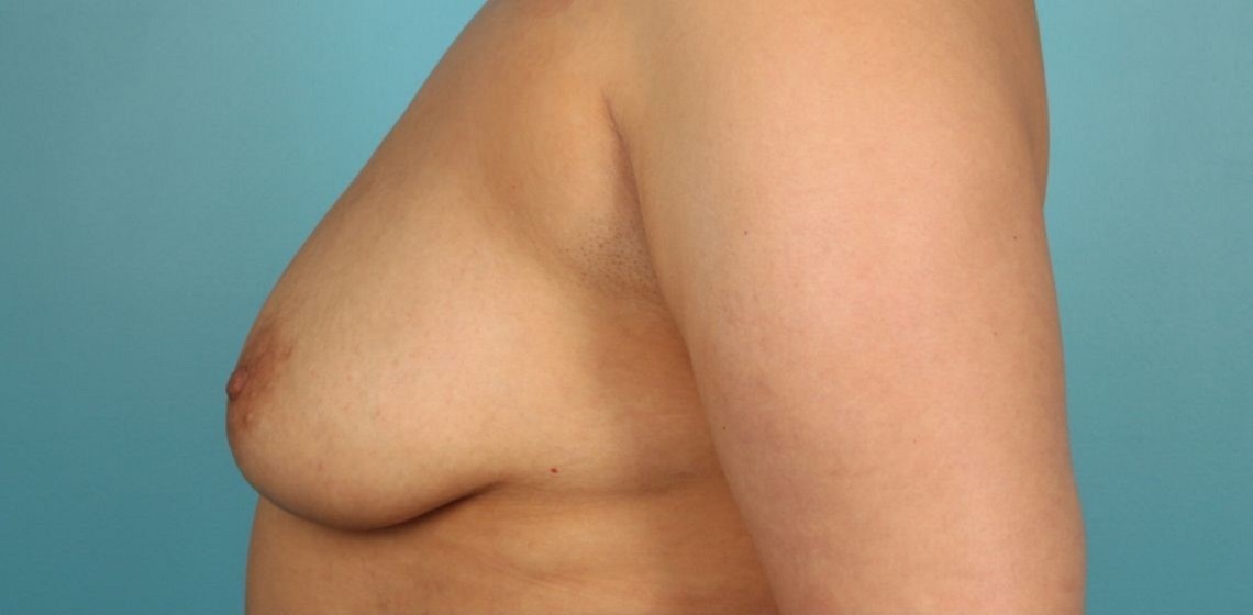 before breast reconstruction left view of female patient 716 at Paydar Plastic Surgery