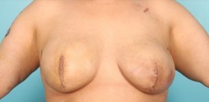 Patient Breast Reconstruction Thumbnail After 0