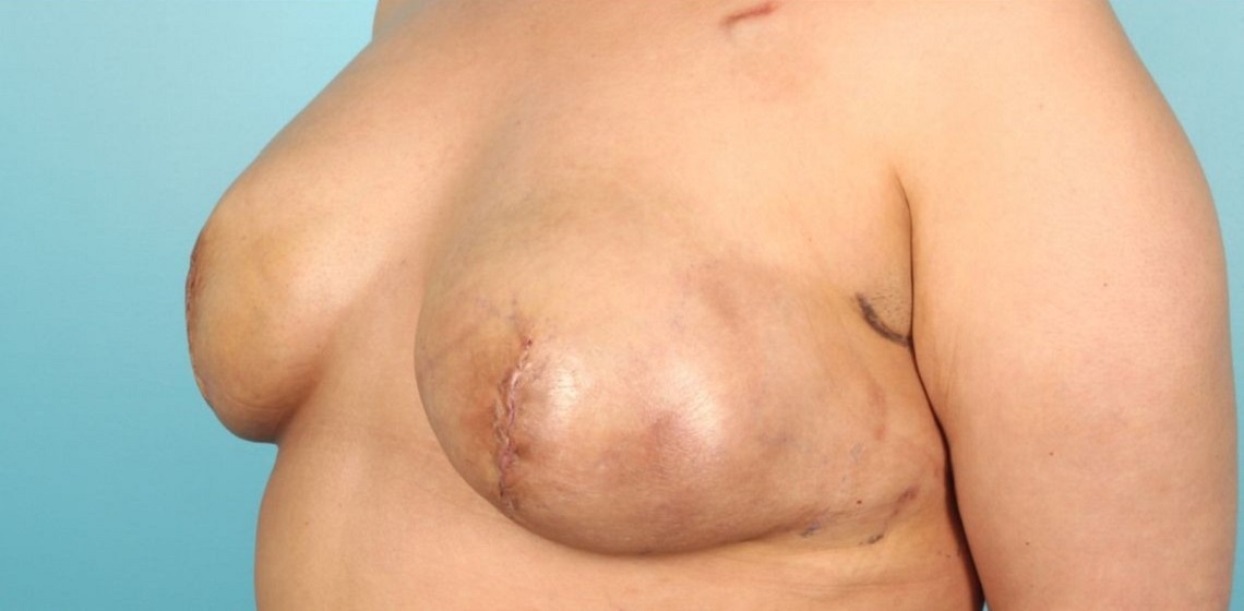 Patient Breast Reconstruction Before 1