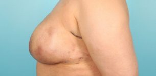 Patient Breast Reconstruction Thumbnail After 2