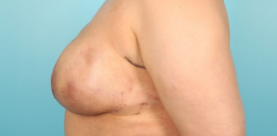 Patient Breast Reconstruction Before 2