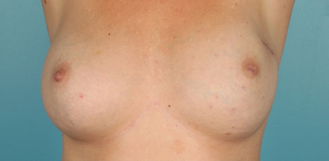 before breast reconstruction front view of female patient 725 at Paydar Plastic Surgery