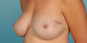 before breast reconstruction left angle view of female patient 725 at Paydar Plastic Surgery