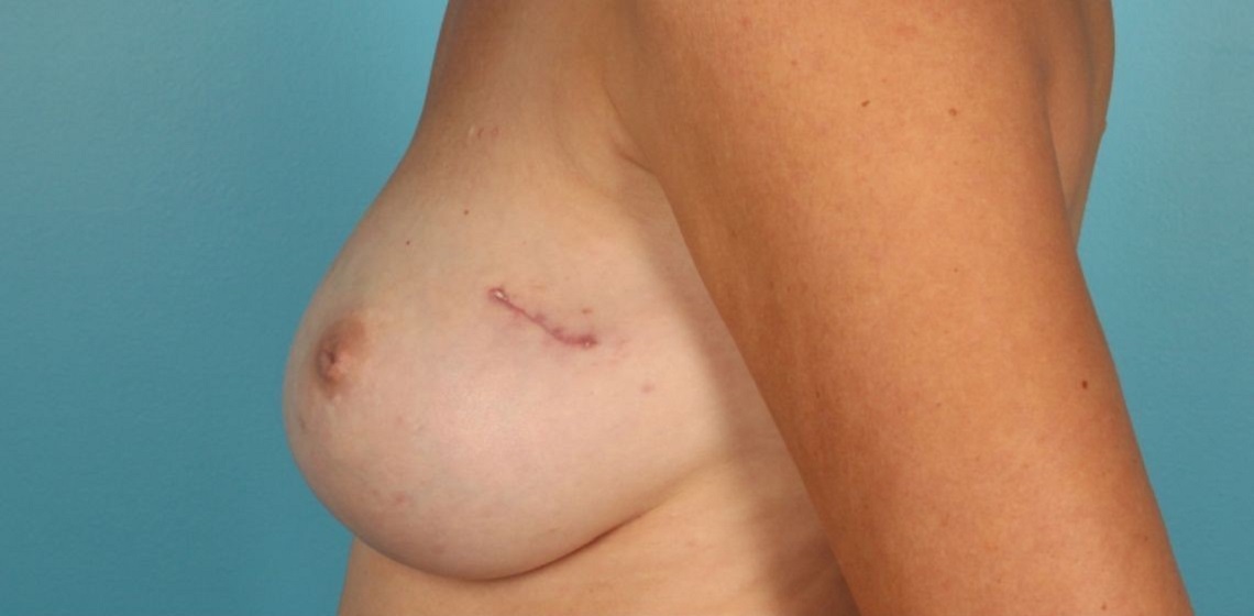 before breast reconstruction left view of female patient 725 at Paydar Plastic Surgery
