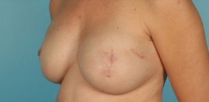 after breast reconstruction left angle view of female patient 725 at Paydar Plastic Surgery