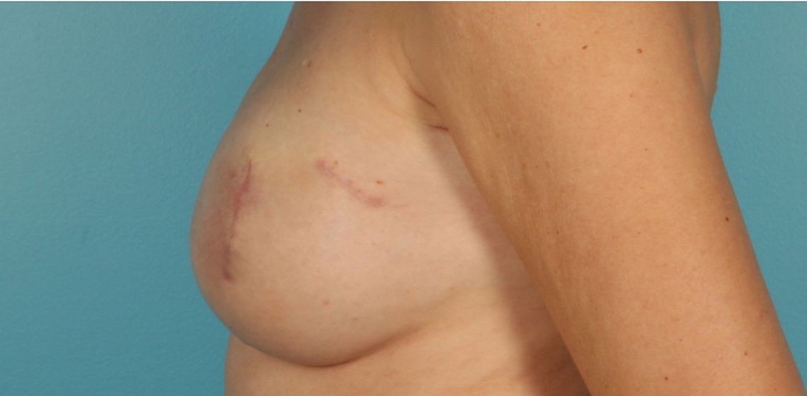after breast reconstruction left view of female patient 725 at Paydar Plastic Surgery