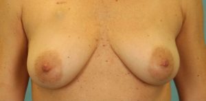 before breast reconstruction front view of female patient 739 at Paydar Plastic Surgery