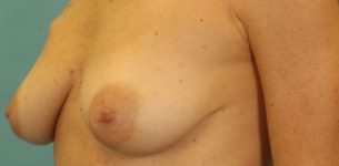 before breast reconstruction left angle view of female patient 739 at Paydar Plastic Surgery