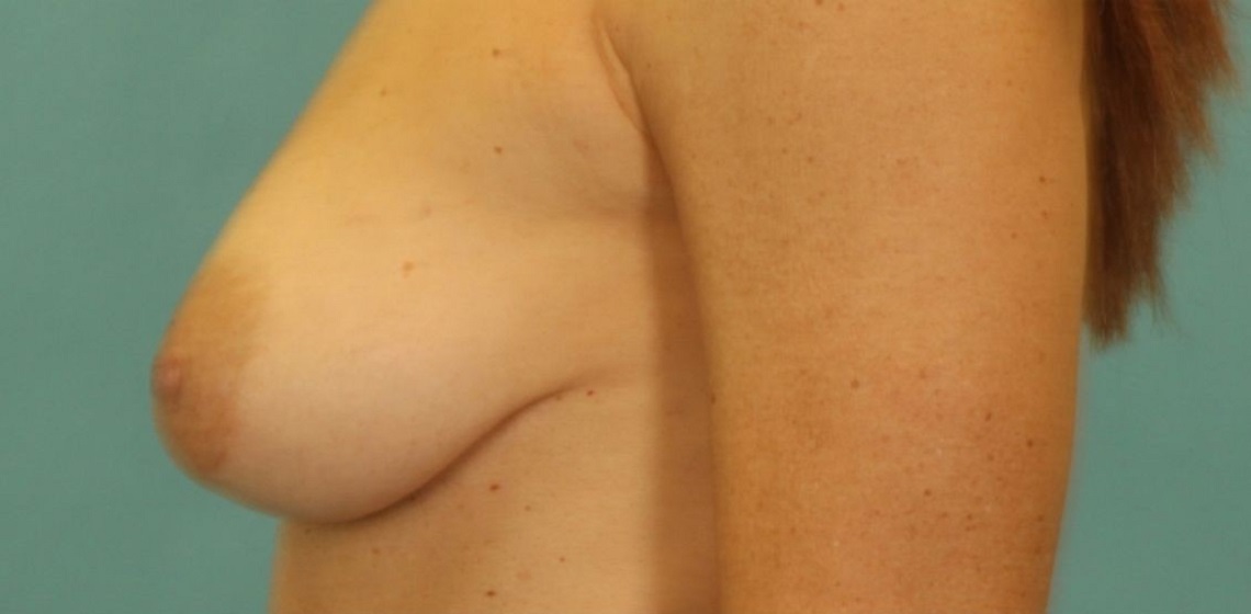 before breast reconstruction left view of female patient 739 at Paydar Plastic Surgery