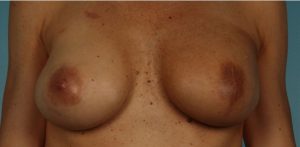 after breast reconstruction front view of female patient 739 at Paydar Plastic Surgery
