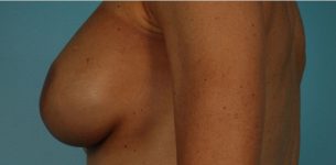 after breast reconstruction left view of female patient 739 at Paydar Plastic Surgery