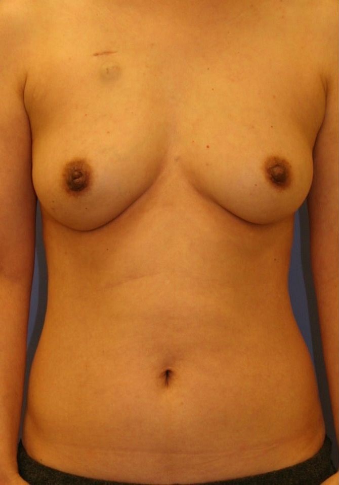 before breast reconstruction front view case 762