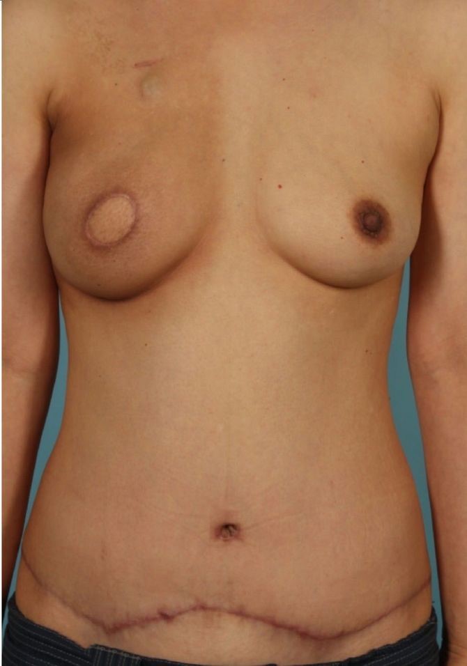 after breast reconstruction front view case 762