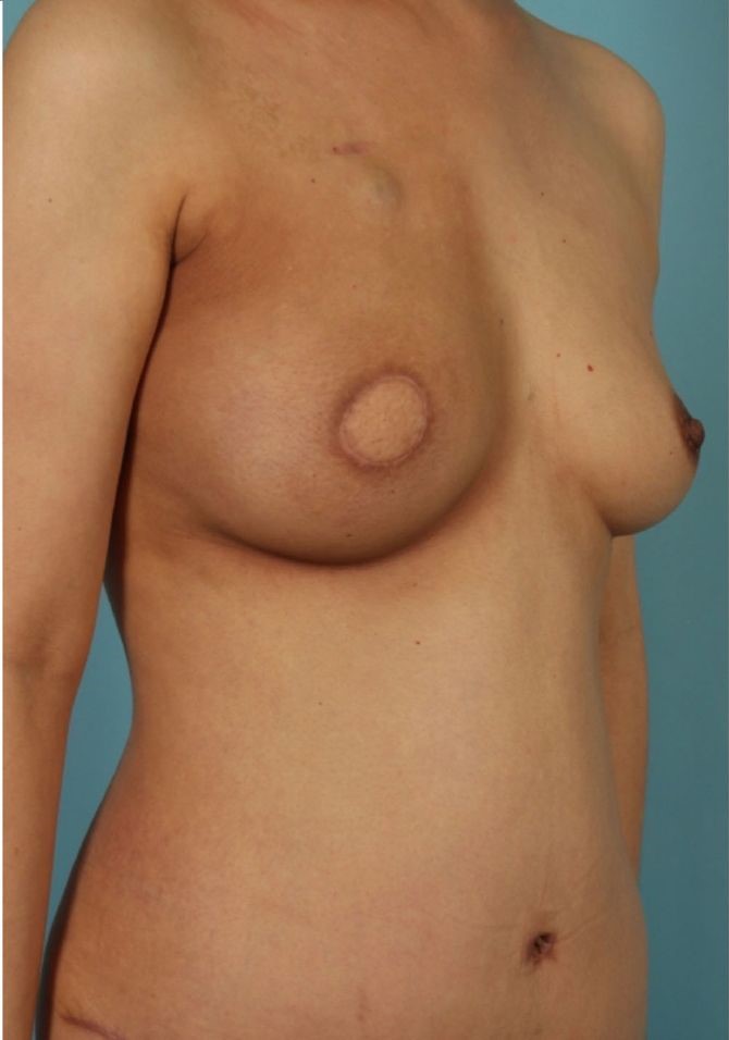 after breast reconstruction angle view case 762