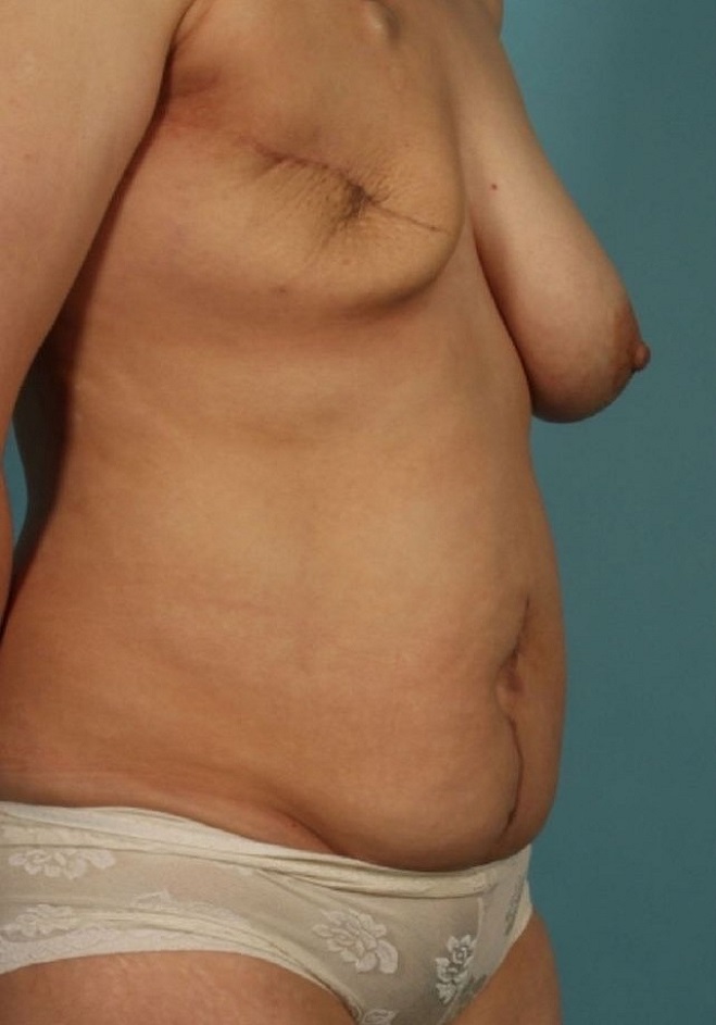 before breast reconstruction angle view case 769