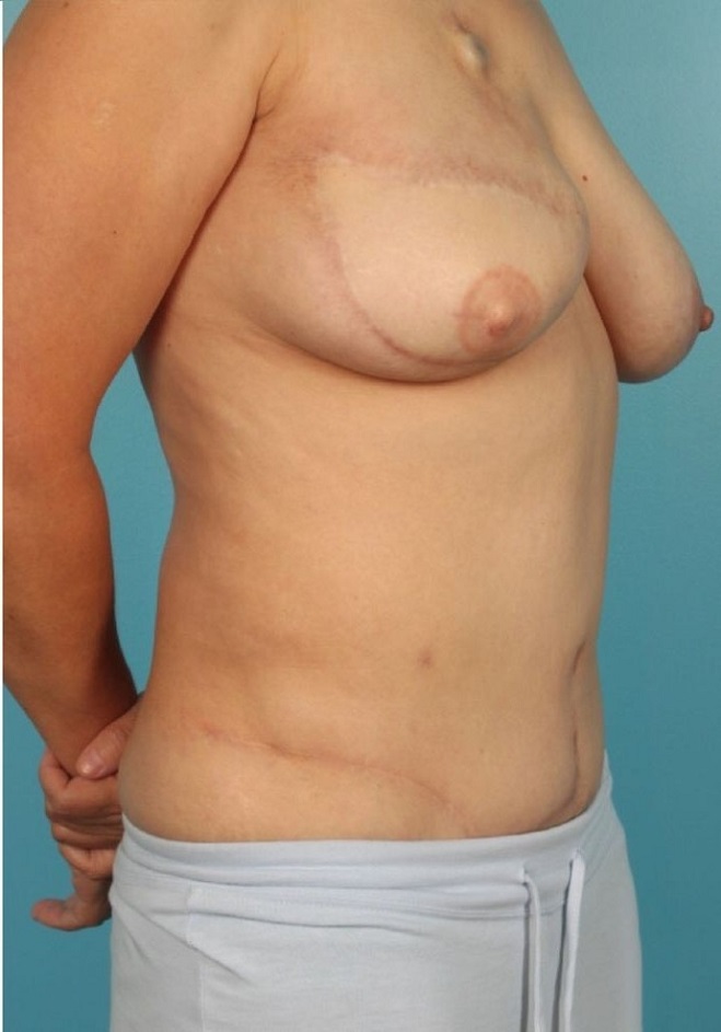after breast reconstruction angle view case 769