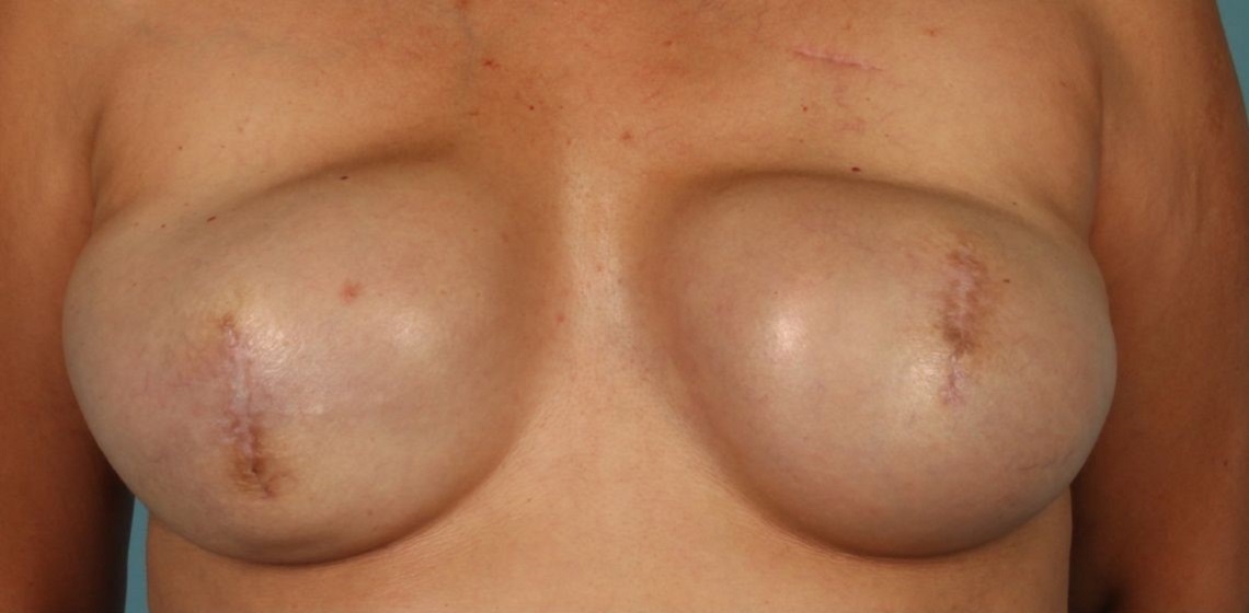 Patient Breast Reconstruction Before 0