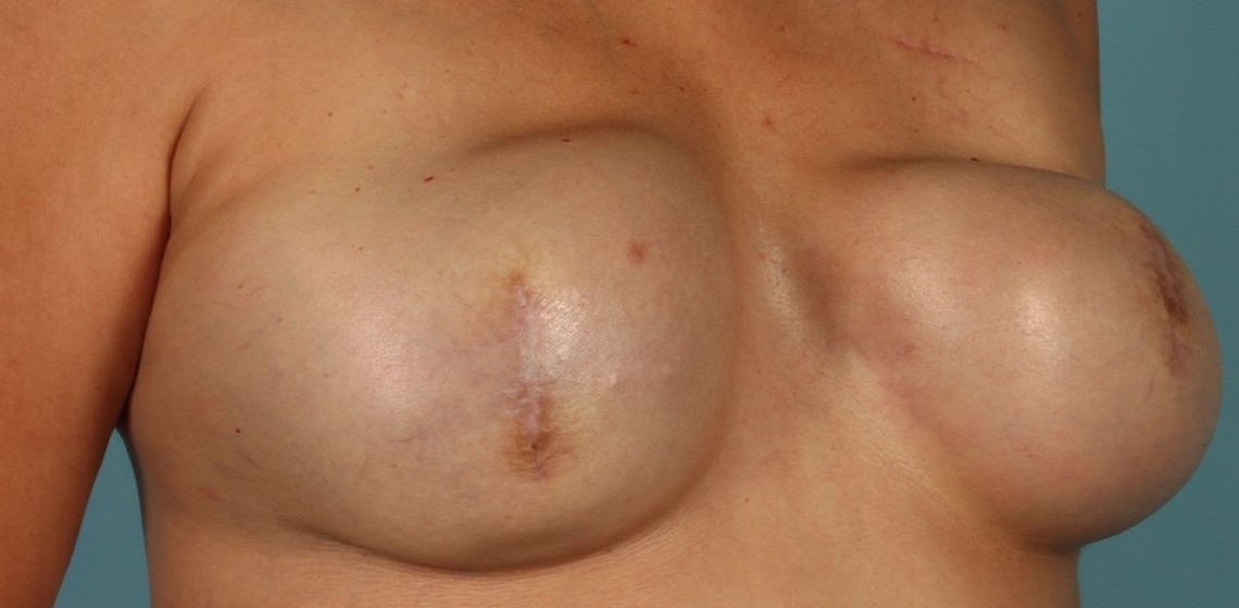 before breast reconstruction angle view case 790