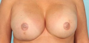 after breast reconstruction front view case 790