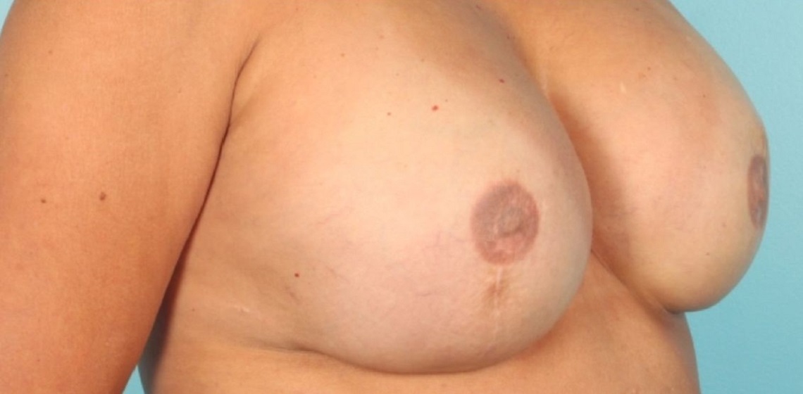 Patient Breast Reconstruction Before 1