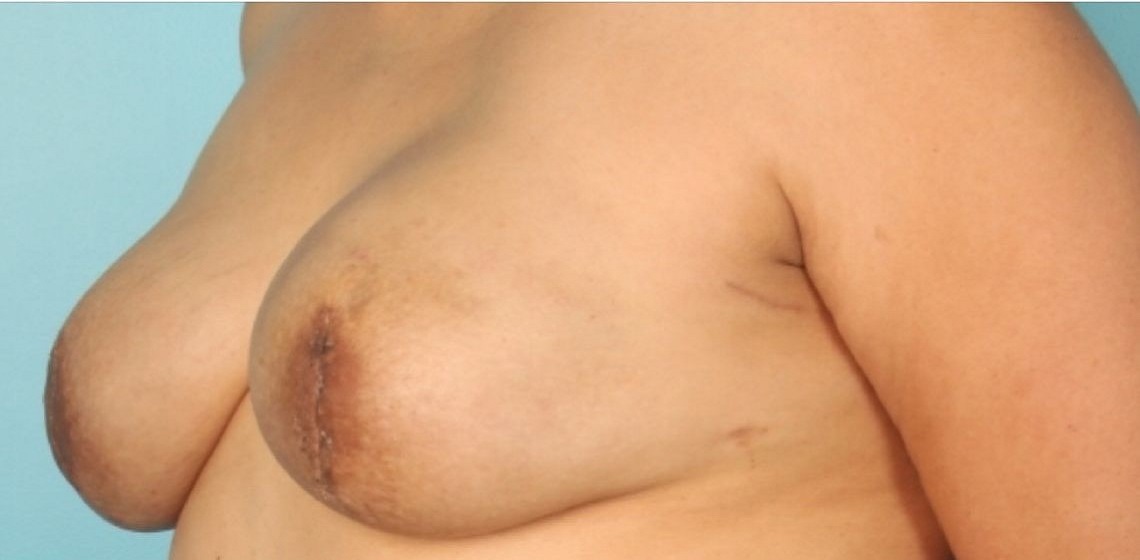 after breast reconstruction angle view case 805