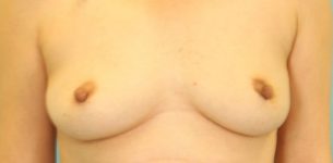 Patient Breast Reconstruction Thumbnail Before 0