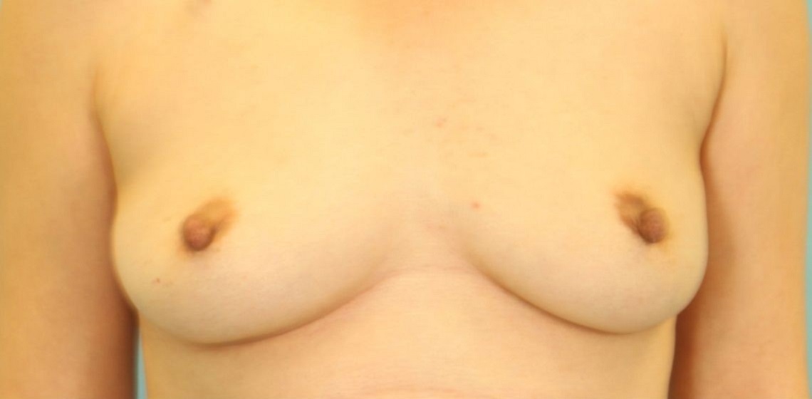 Patient Breast Reconstruction Before 0