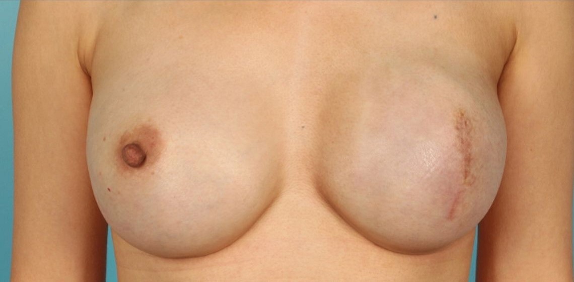 after breast reconstruction front view case 814