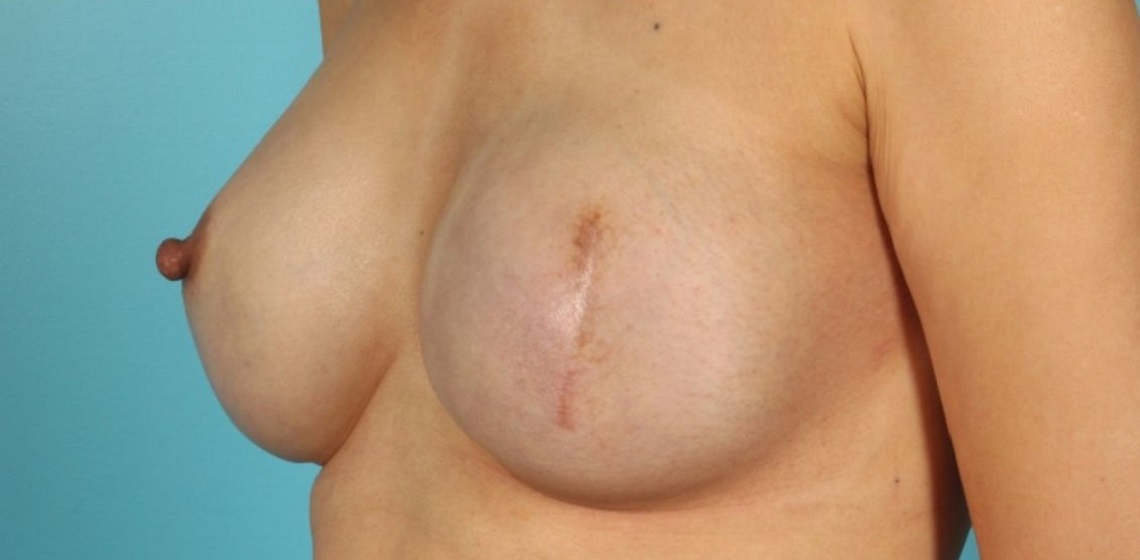 Patient Breast Reconstruction Before 1