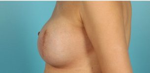 Patient Breast Reconstruction Thumbnail After 2