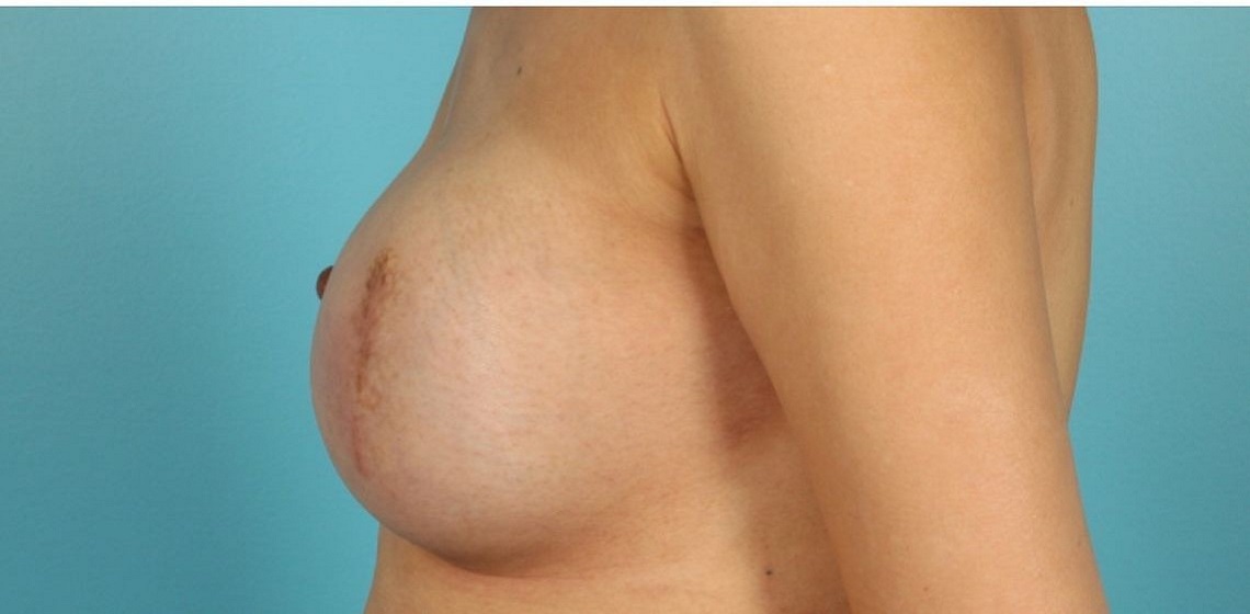 Patient Breast Reconstruction Before 2