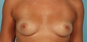Patient Breast Reconstruction Thumbnail Before 0