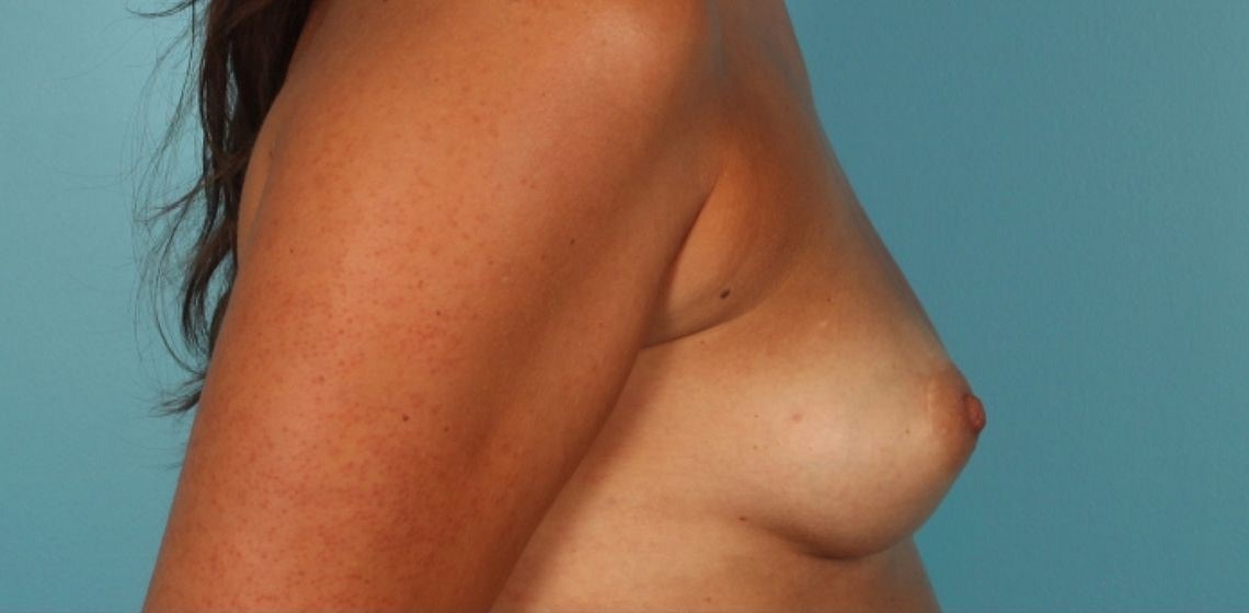 Patient Breast Reconstruction Before 2