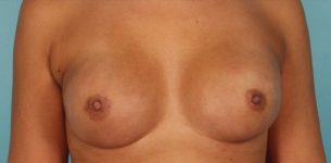 Patient Breast Reconstruction Thumbnail After 0