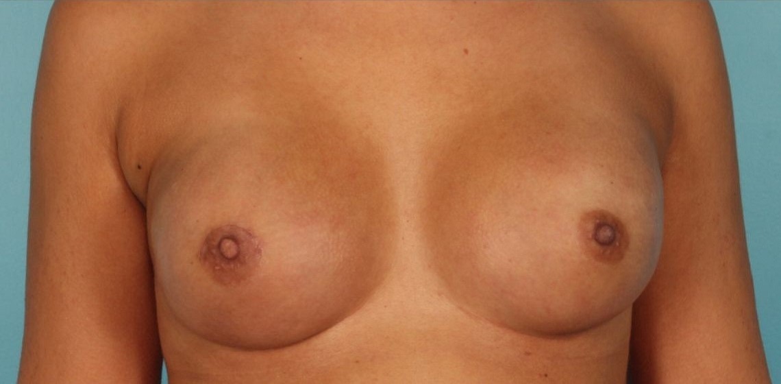 Patient Breast Reconstruction Before 0