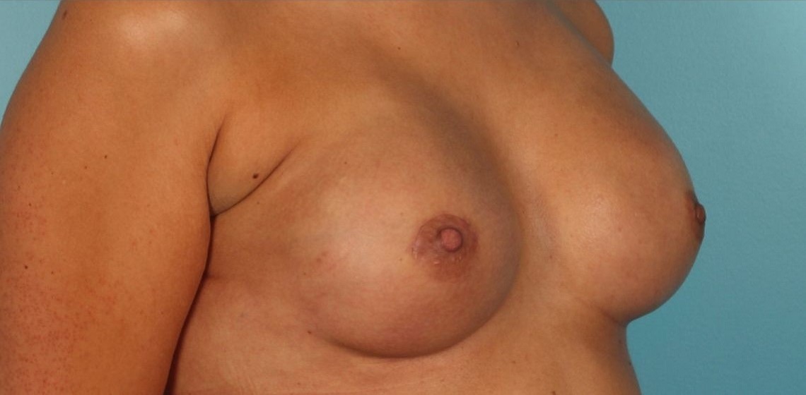 Patient Breast Reconstruction Before 1
