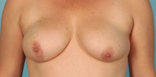 Patient Breast Reconstruction Thumbnail Before 0
