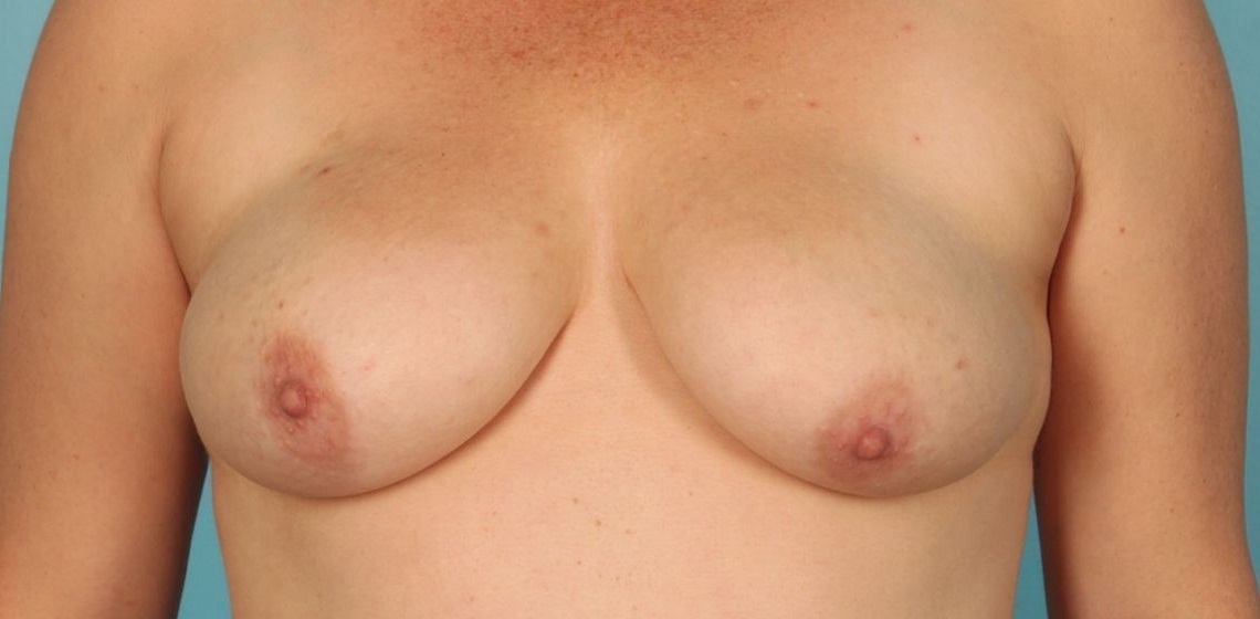 Patient Breast Reconstruction Before 0