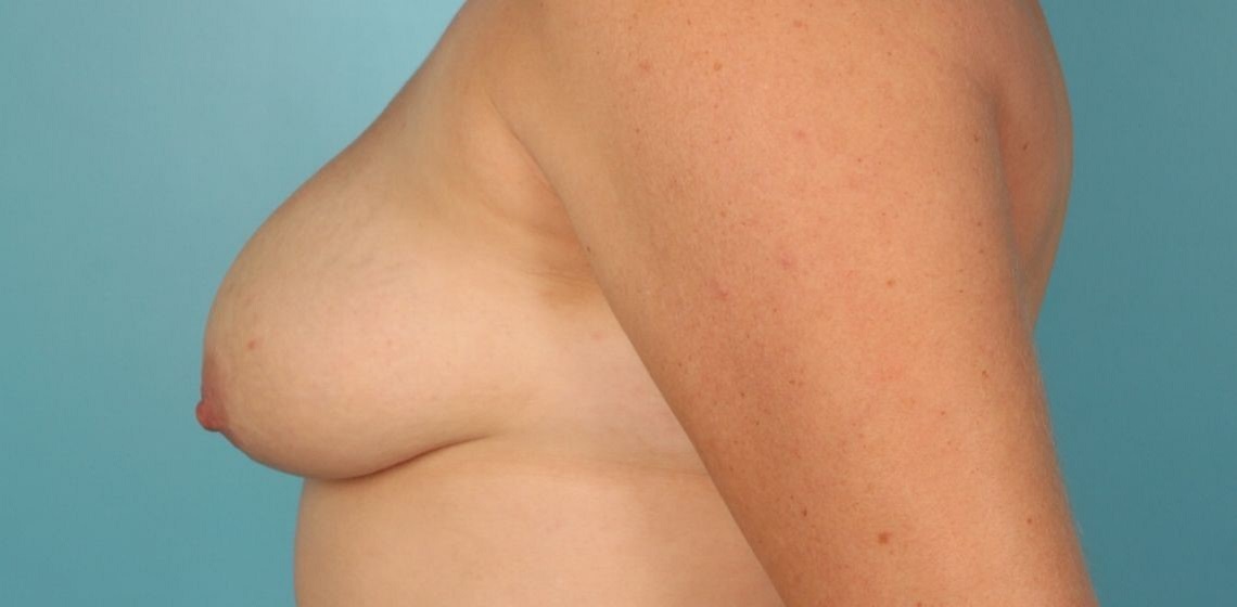 Patient Breast Reconstruction Before 2