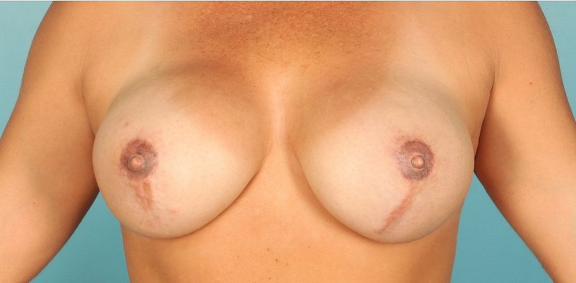 Patient Breast Reconstruction Before 0